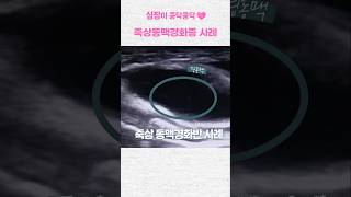 죽상동맥경화증(동맥경화) 관리 방법